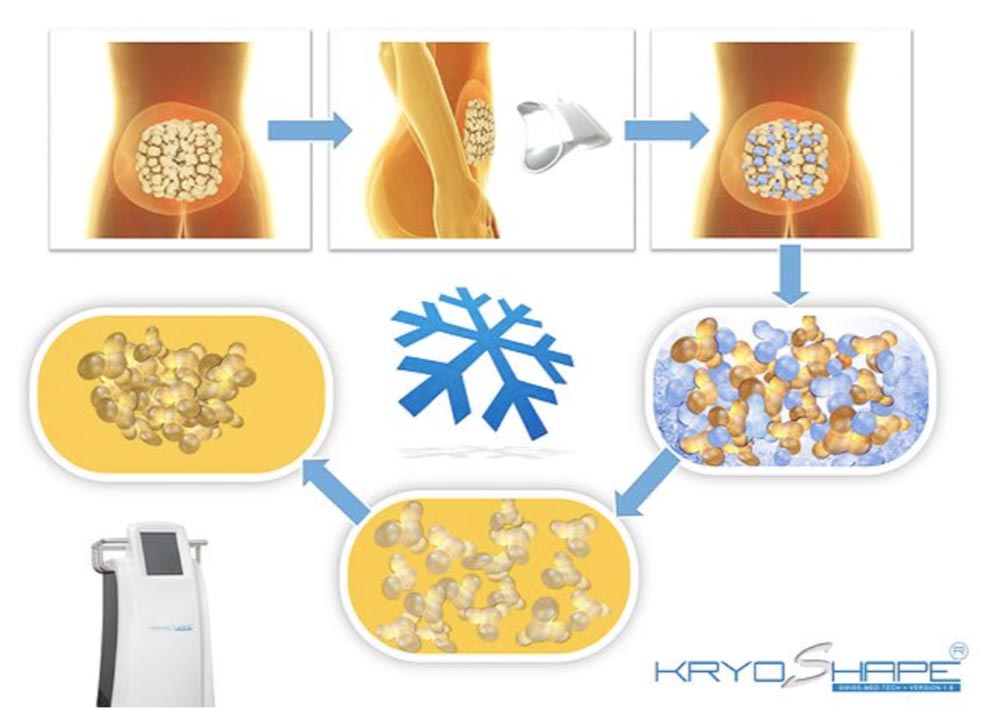 Kryolipolyse Hannover 